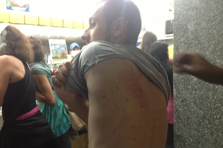 Jornalista Fernando Mellis mostra a marca do golpe que recebeu do policial. (Crédito: Daia Oliver/R7).